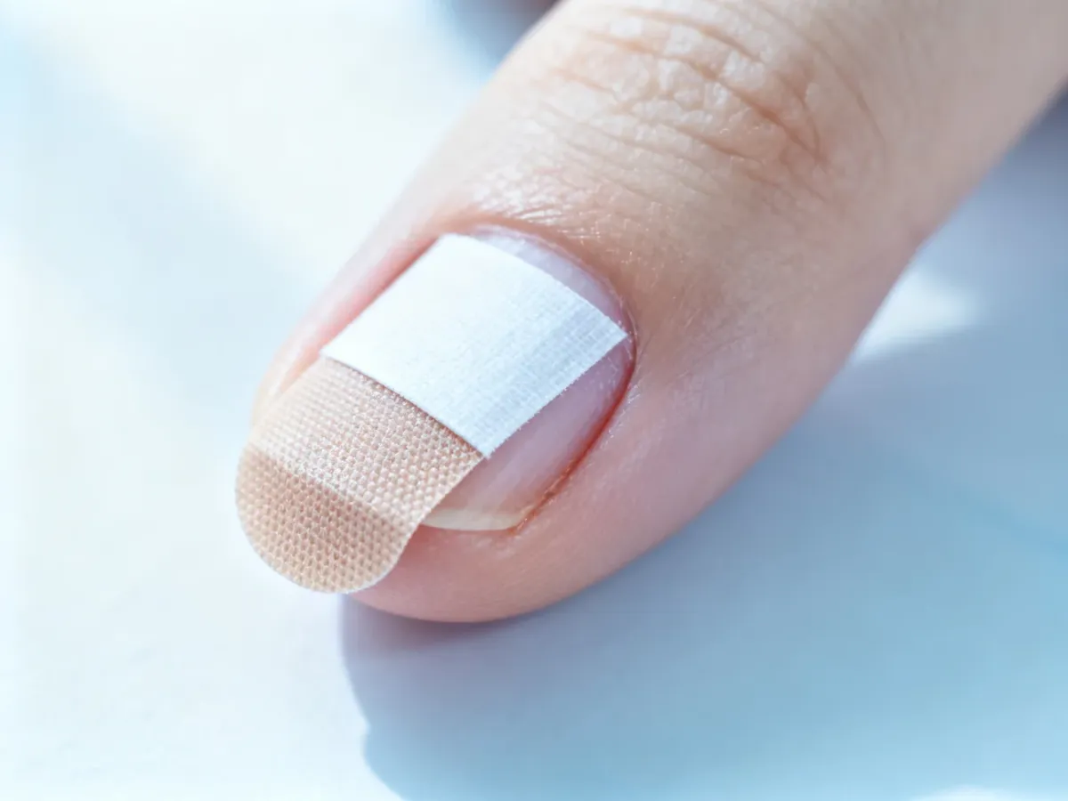 Plaster korygujący naklejony na paznokieć u nogi, obrazujący sposób działania metody na wrastające paznokcie.
